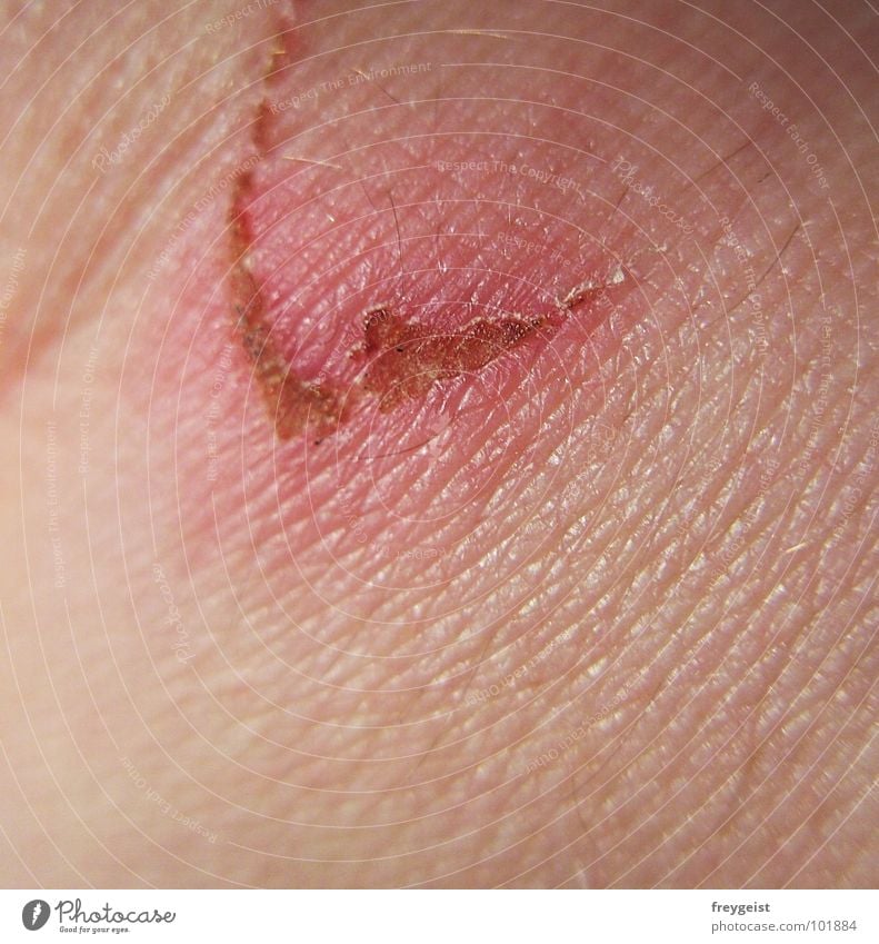 ow Scratch mark Wound Illness Detail wound healing Pain