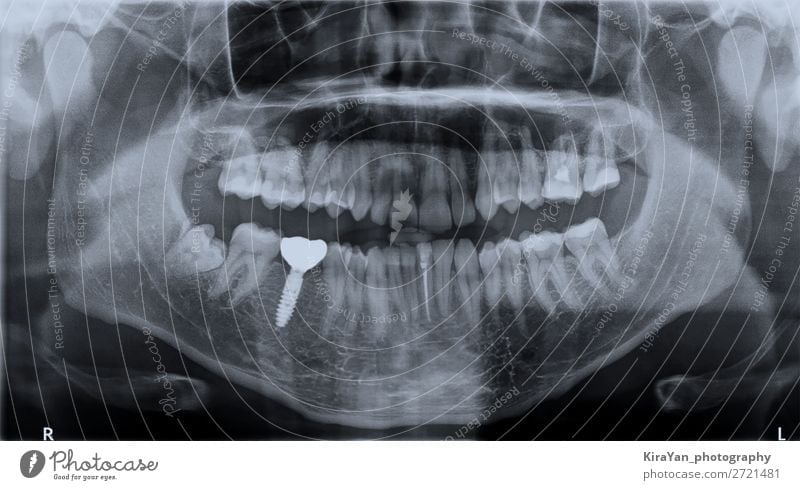 Roentgen teeth upper and lower jaw Medication Human being Mouth Teeth Blue Wisdom Radiology Dental Ray Placeholder endosseous Jaw medicine implant surgery