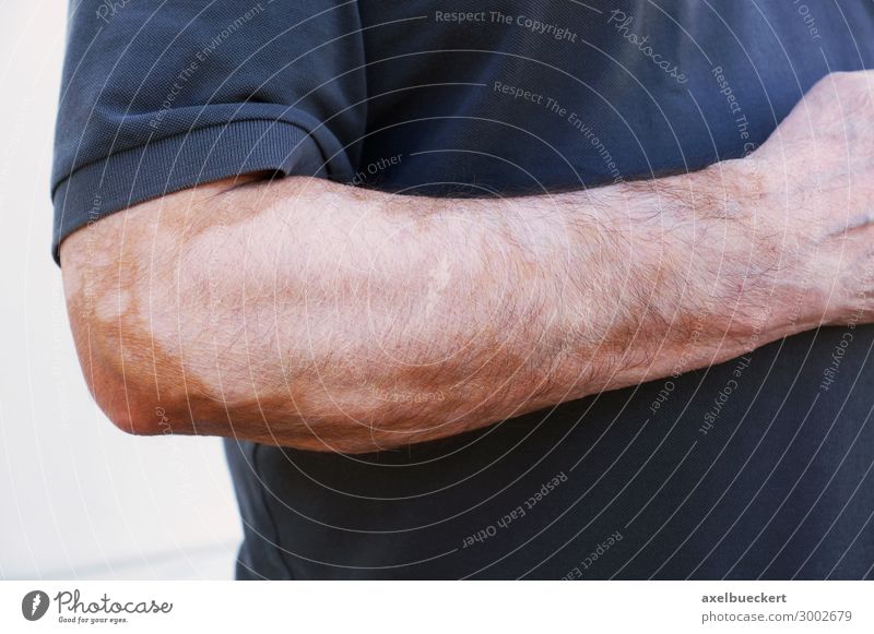 vitiligo or white spot disease or check skin Health care Human being Masculine Man Adults Skin Arm Hand 1 45 - 60 years Illness White Leucopathia acquisita