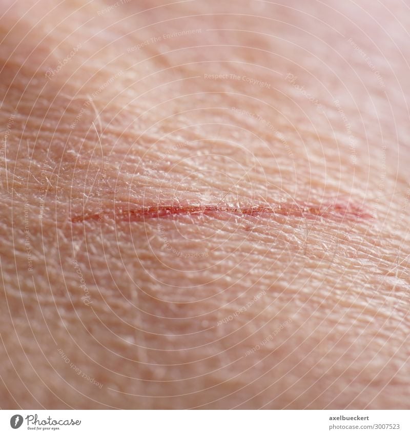 Scratched or scratched skin Health care Human being Adults Skin 1 Authentic Wound Laceration Scratch mark Scrape Crust Small Colour photo Close-up Detail