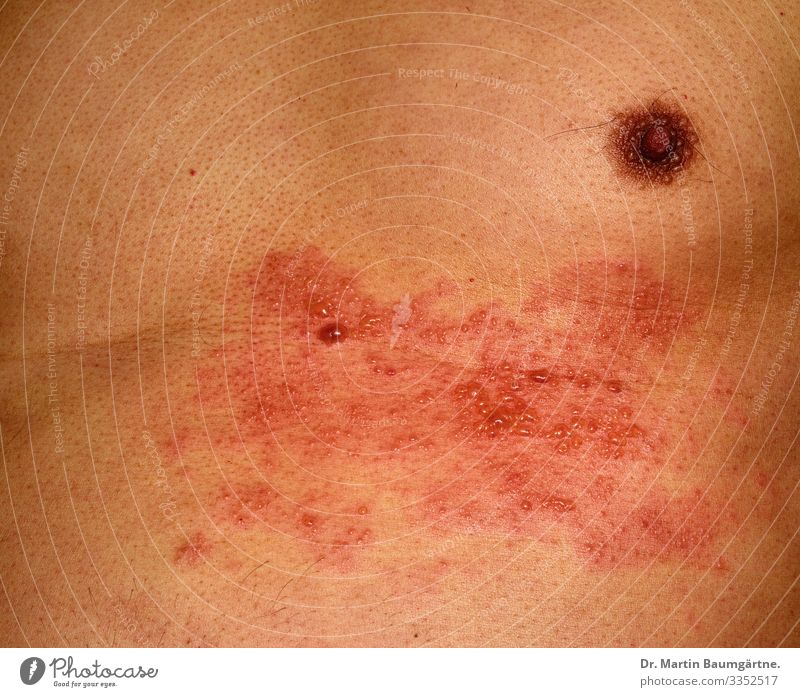 Shingles - herpes zoster; shingles Human being Masculine Man Adults Skin Chest 1 45 - 60 years Fat Illness Naked Brown Red Herpes painful rash disease viral