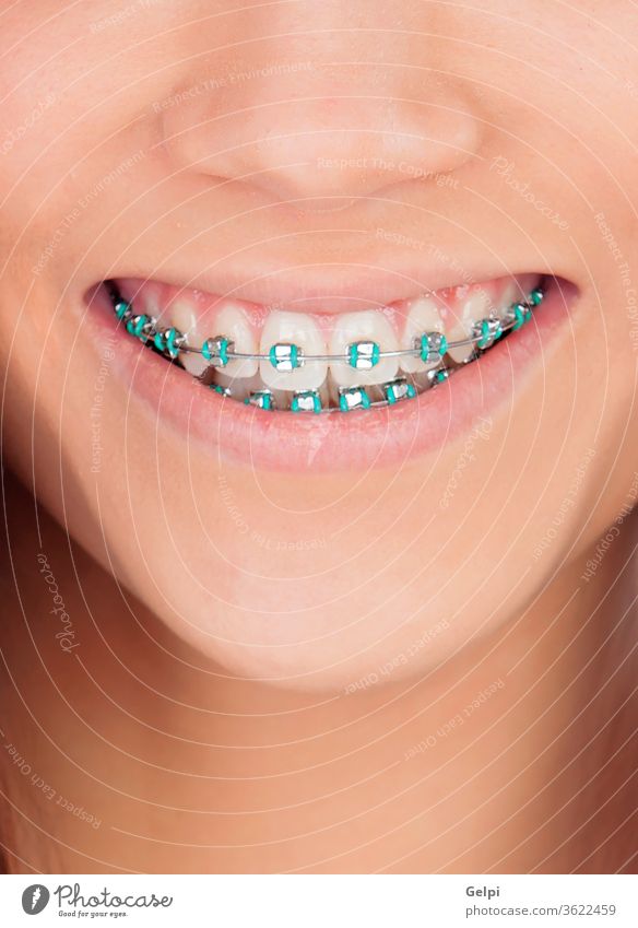 Portrait of a young girl with brackets dental mouth female white beautiful smile happy lips healthy beauty metal hygiene closeup orthodontic correction