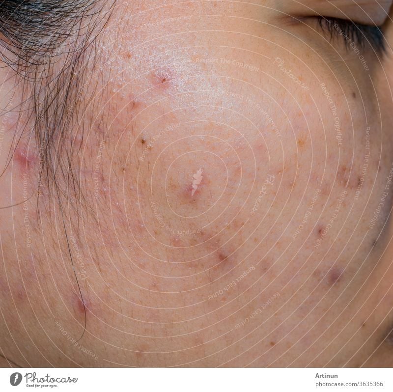 Acne and acne spot on oily face skin of Asian woman. Concept before acne treatment and face laser treatment for get rid of dark spot post-acne. Closed comedones and open comedones on facial skin