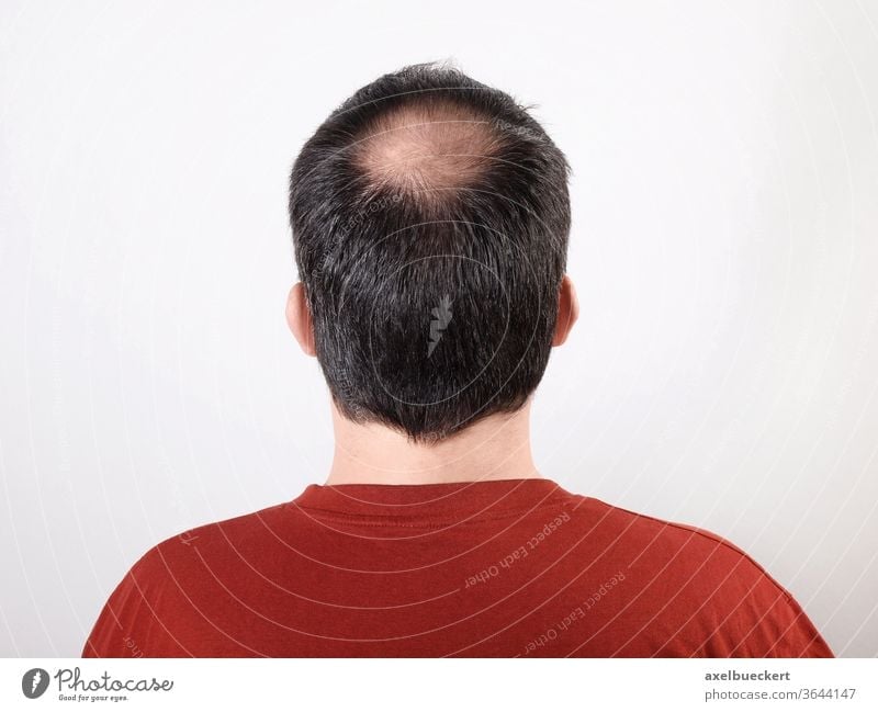 hair loss Hair loss Androgenetic hair loss Alopecia bald spot Upper head Tonsure Back of the head Bleak Man Head Aging baldness Anonymous Healthy more adult