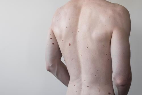 Male torso with a lot of moles, body health birthmark back dermatology skin medical melanoma care dermatologist spot disease naked human person brown adult