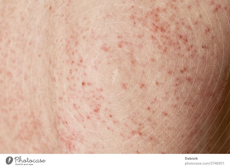 Allergic rash on skin. Woman with dermatology problem on back skin allergy eczema infection disease health medical body red dermatitis epidermis closeup