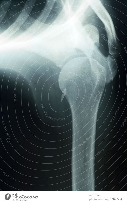 X-ray shoulder joint X-ray photograph Joint Shoulder Joint Radiology Diagnosis Technology Health care Skeleton Bone X-rays