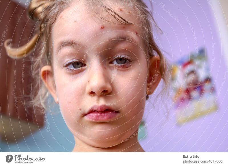 Portrait of child has skin infected with chickenpox Ache Bacteria Blisters Bubble Care Caucasian Chickenpox Child Contagious Cry Dermatology Disease Emotion