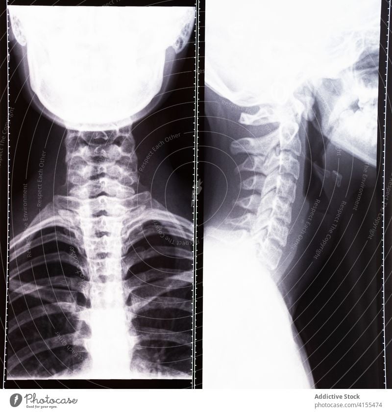 X ray image of neck cervical spine x ray column skull medicine health care diagnostic scan mri medical treat human body diagnosis surgery bone anatomy skeleton