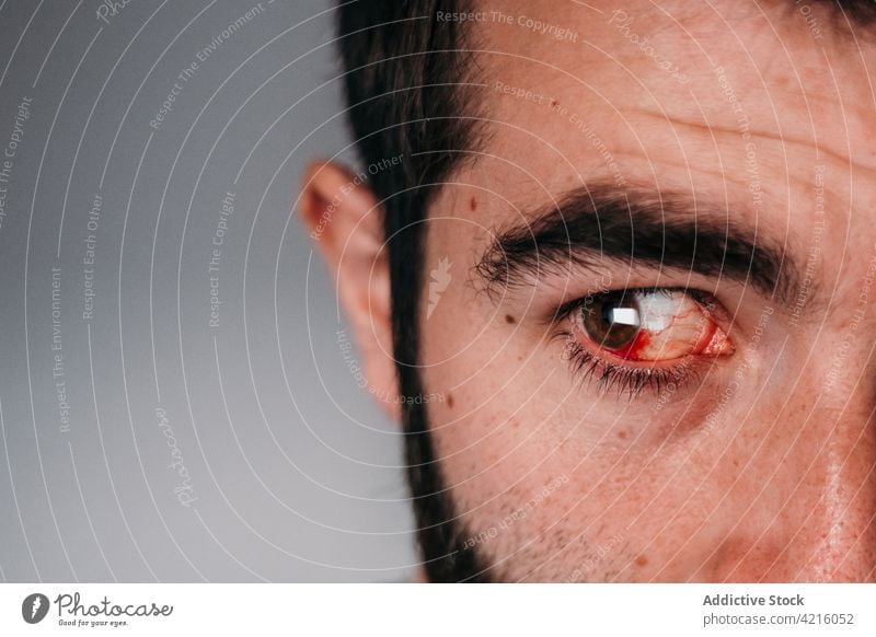 Man with bloodshot eye looking away man red vein inflame irritate infection sick injury male sore unhealthy problem symptom illness suffer unwell disease pain