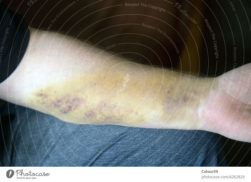 Allergy on the arm allergy skin disease health medical care hand allergic patient illness reaction medicine rash epidermis dermatitis pain dermatology people
