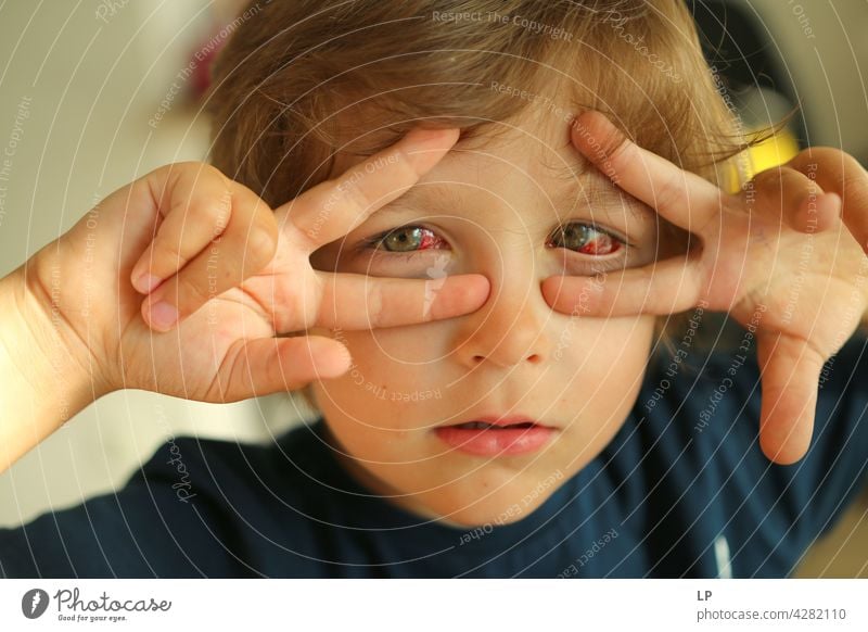 child with red eyes looking at the camera Red Eyes Illness Conjunctivitis Surgery serious treatment liver disease cause health care dry eye symptom cirrhosis