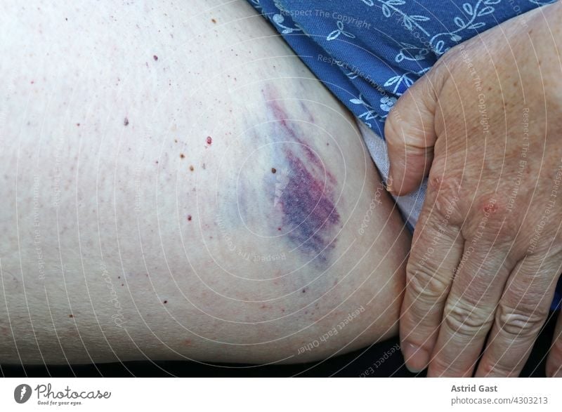 A woman has a large painful bruise (bruise) on the inside of her thigh. Woman leg Contusion bruised violation Wound Thigh inner thigh inside leg bleed bloody