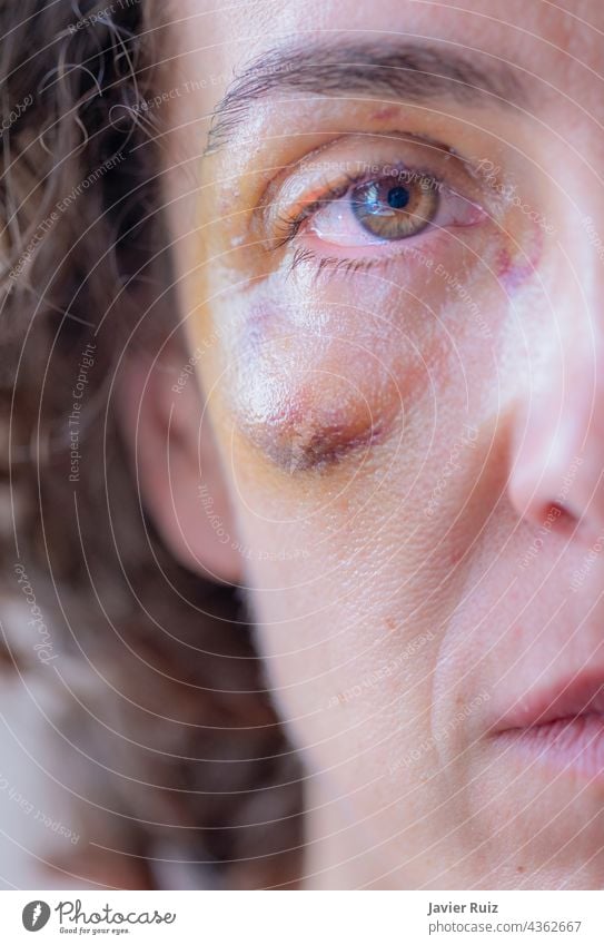 close up of a battered or abused woman with a black eye, showing only half a face violence gender violence abusive cruelty eyes hide shame victim emergency