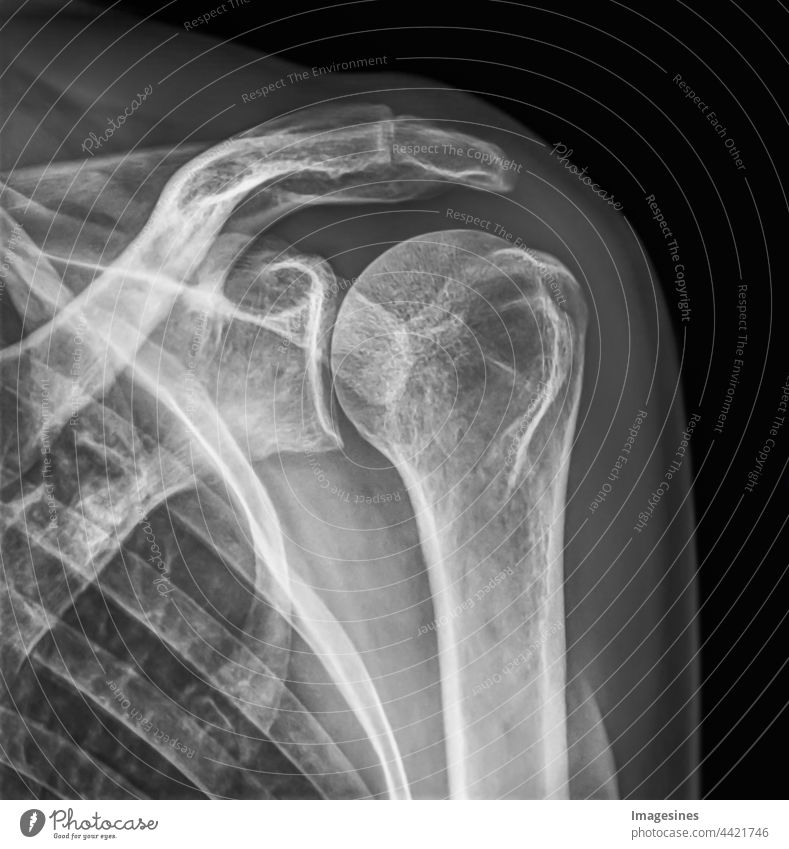 X-ray image of female healthy body. X-ray image of female shoulder isolated on black background. Adults Anatomy arm Biceps Biology Biomedicine Bone