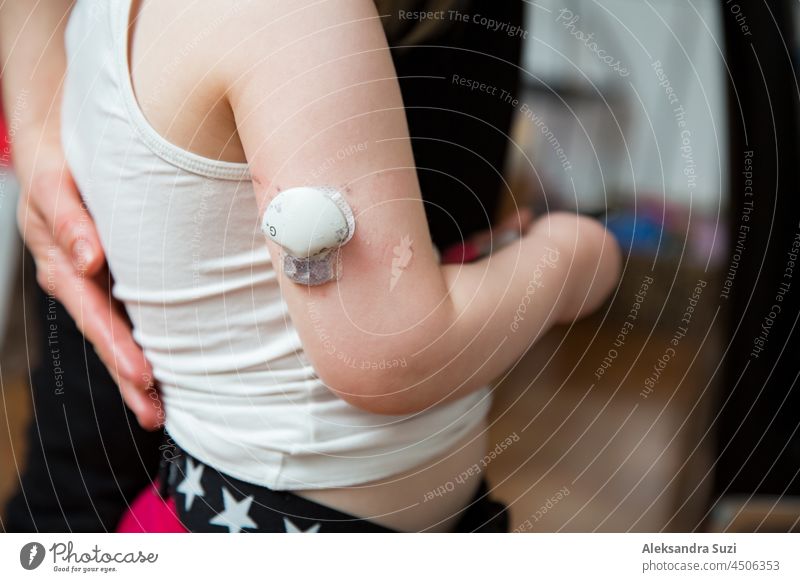 Little child having the diabetics sensor of the glucose monitoring system on arm. Diabetes treatment for kids baby scanning diabetes adhesive blood body care