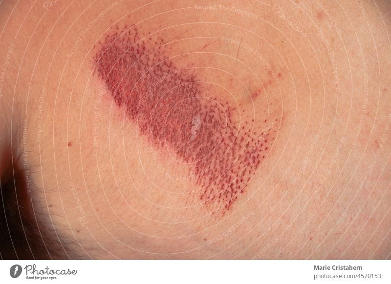 Close up of an abrasion wound in Caucasian skin caucasian skin injury close up medical healthcare skin abrasion skin texture pattern rough scrape macro harm