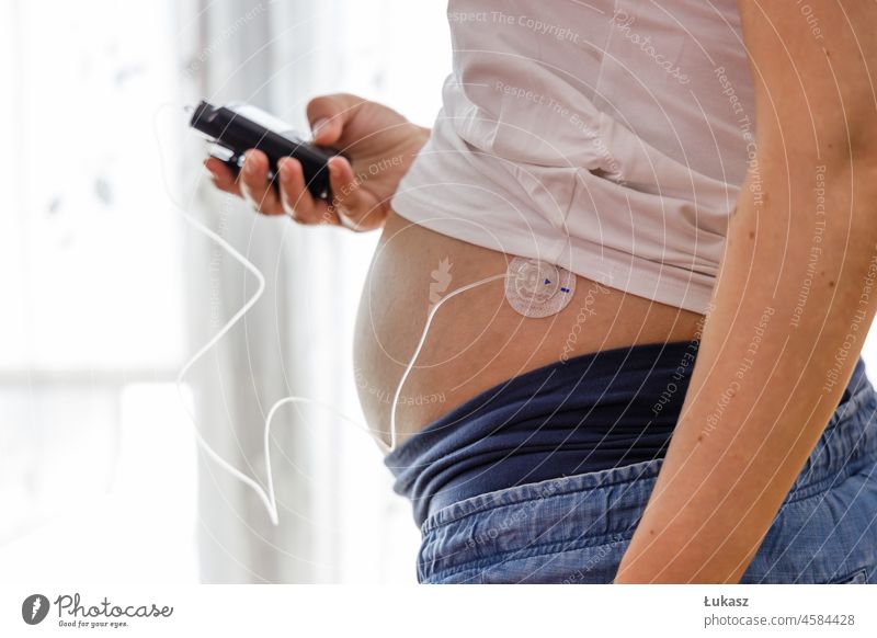 A pregnant woman operates an insulin pump. Modern diabetes treatment using insulin administered through a drainage tube attached to the abdomen. Level Remote