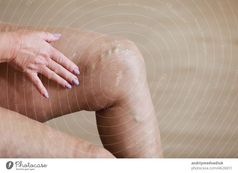 The woman rubs tired legs with a special cream to reduce pain. Phlebology. Painful varicose and spider veins on active female legs, medicine and health. skin