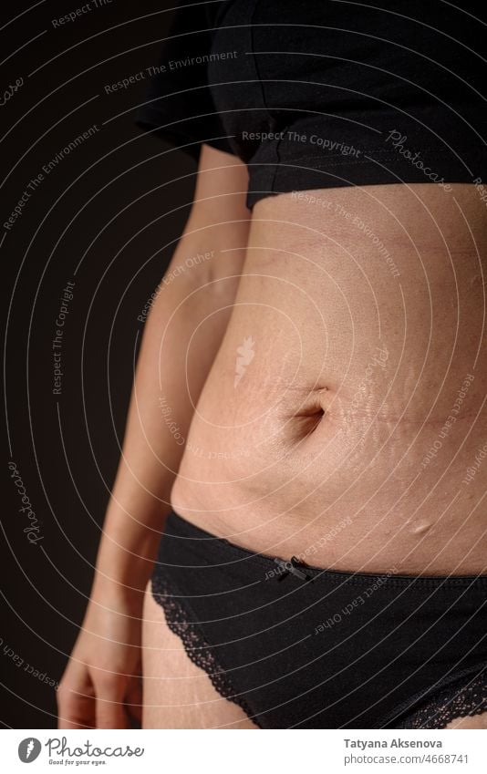 Woman belly with stretch marks and scars woman skin body abdomen stomach body positivity female real body person health tummy fat pregnancy striae shape waist