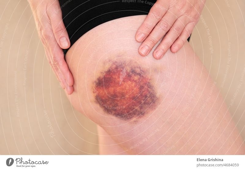 Hematoma on a woman's leg close up. Huge bruise on the leg of a woman. hematoma closeup trauma purple concept violence accident health injury skin pain female