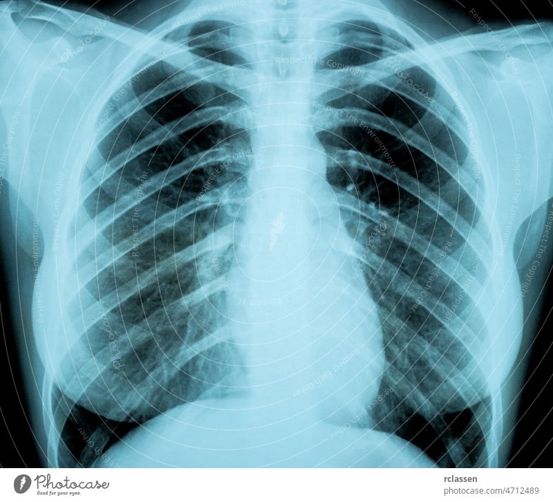 X-Ray Image Of Woman Chest for a medical diagnosis x xray x-ray admission Radiograph anatomy doctor medicine surgery transparenz body hospital human