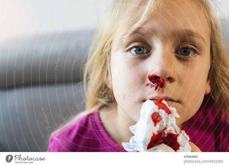 Child Trying To Stop Blood Bleeding From Nose. Epistaxis of a child. Blood from the nose Close-up, nose bleeding epistaxis ache allergy anemia atherosclerosis