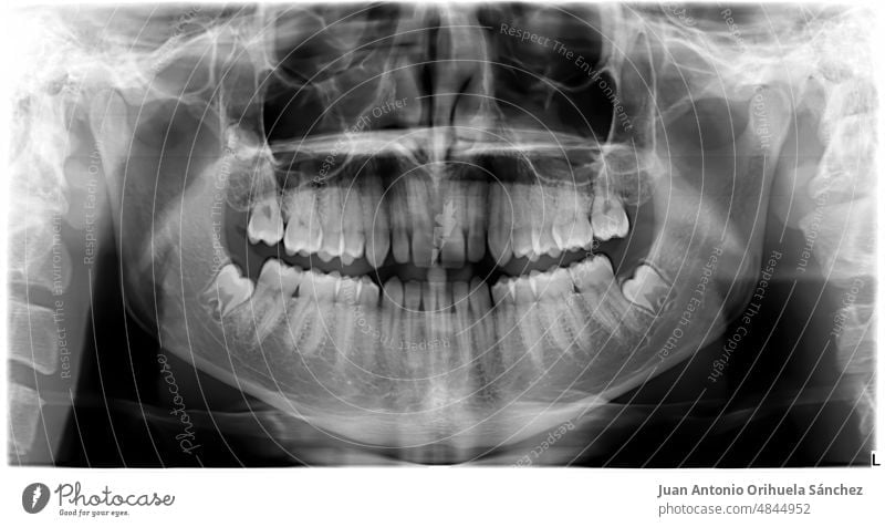 Pantography of the perfect teeth of a healthy young man. X-ray of a human mouth. pantography scanning orthopantomogram caries implant stomatology toothache