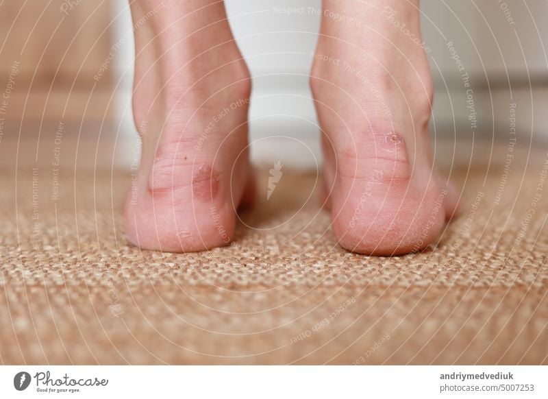 Callus blisters on woman feet. Painful wounds. Uncomfortable shoes problems. View of foot with inflammatory corns. Health and beauty concept. callus care female