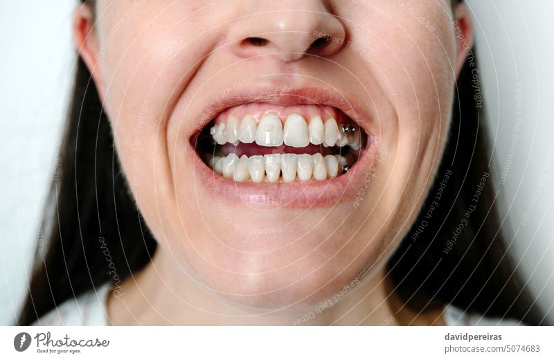 Woman with open mouth showing attachments and dental buttons for orthodontic treatment unrecognizable woman female teeth tooth bite ramp movement rotation
