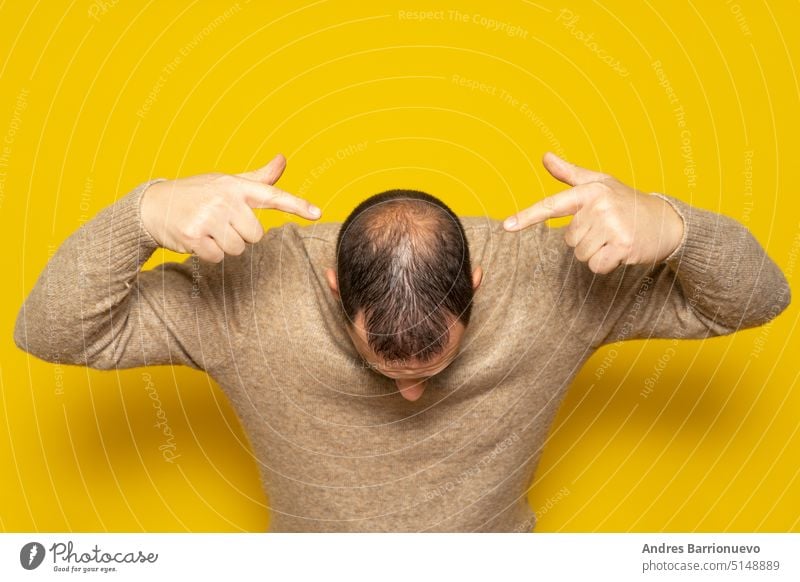 Human alopecia or hair loss. Middle-aged Latino man pointing to his head highlighting his incipient alopecia rear nape patch mature latin hairline years stubble