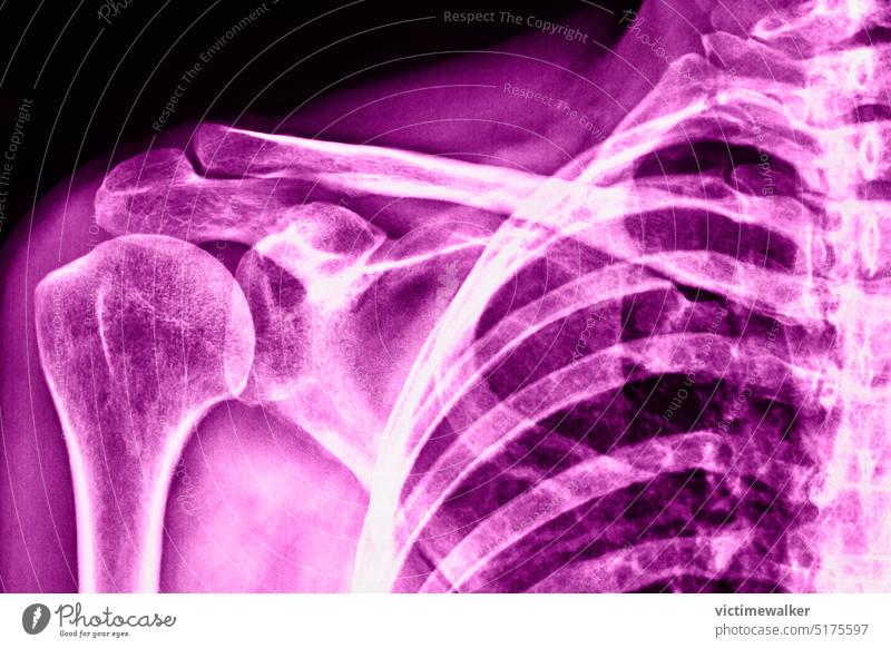 Close up of shoulder x-ray medical bones pink color health background healthcare anatomy human body part body care science patient surgical nobody