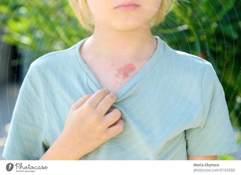 Mark on the skin of chest of eight years old child. Hemangioma is a red birthmark from blood vessels on the skin, benign tumor. hemangioma boy kid dermatology