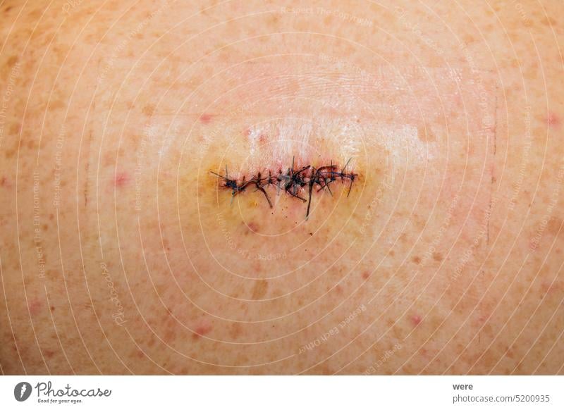 Double sutured scar of abscess surgery on a back antibacterial caucasian disease double emergency room healing hospital pain sepsis sick sterile surgeon wound
