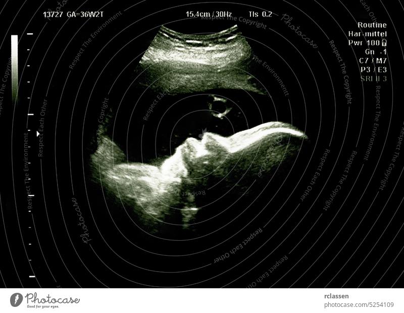 Tiny baby is turning in mother's belly during ultrasonic procedure and make a bubble ultrasound scan sonogram fetus womb pregnancy pregnant sonar
