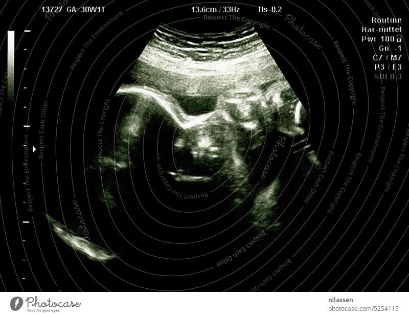 Ultrasound of baby in mother's womb. Echography Scan. ultrasound scan sonogram fetus pregnancy pregnant sonar ultrasonography unborn woman 3d belly isolated