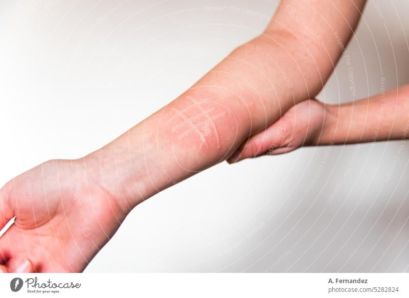 Detail of the arm of a person affected by the skin condition called Dermographism. Skin condition called dermatographism or atopic dermatitis skin ondition