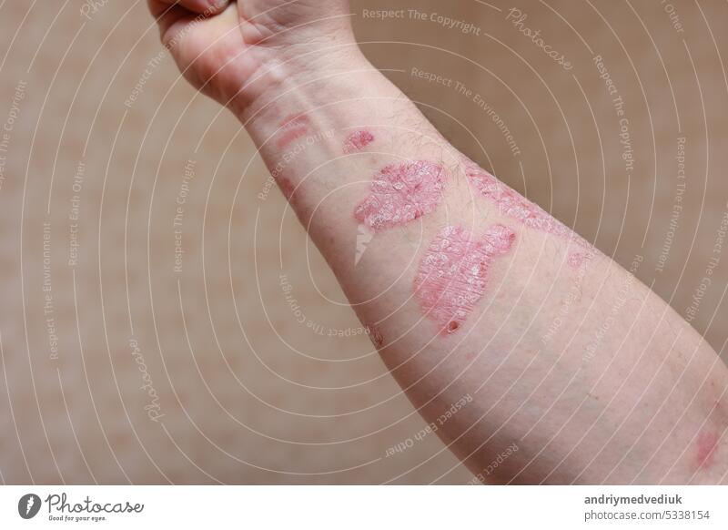 Man with sick arm, dry flaky skin on his hand with vulgar psoriasis sores, allergy, eczema and other skin diseases such as fungus, plaque, rash and blemishes. Autoimmune genetic disease.
