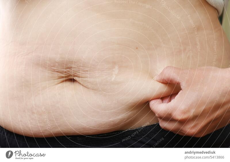 Close up of mother womans belly showing stretch mark loose lower abdomen skin she fat after pregnancy baby birth, studio isolated on white background, Healthy belly overweight excess body concept