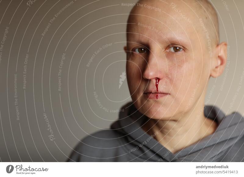 Young bald cancer sick woman is bleeding from her nose, effects of chemotherapy. Female lost her eyebrows and eyelashes and has heavy nosebleed with red blood on the face. Healthcare concept