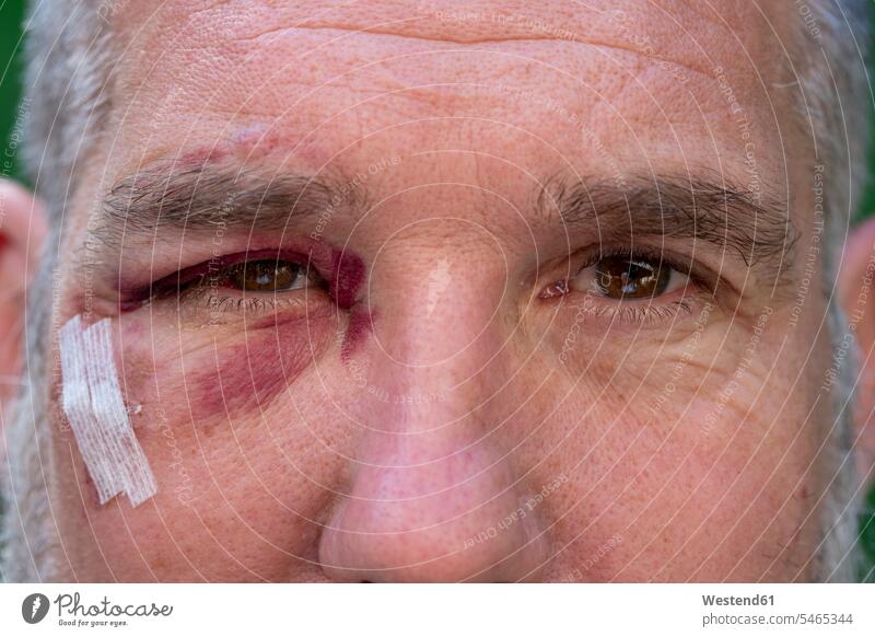 Close-up of man with black eye without people no one indoor interior shot indoors interiour photo interiour photos interiour shots Medical & Healthcare