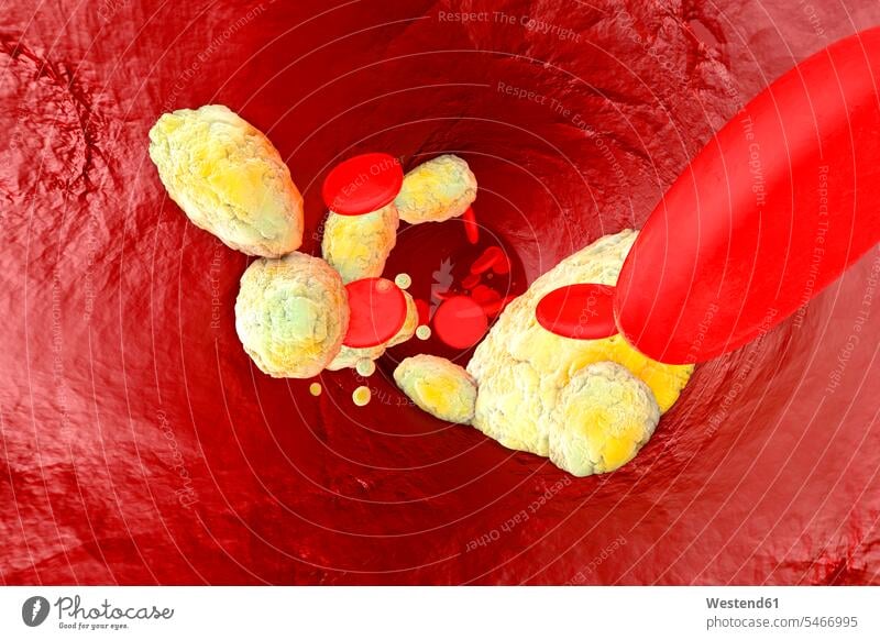 3D Rendered illustration, visualisation of fat clogging a artery and forming the sickness arteriosclerosis constriction constriced cornered spherical shape