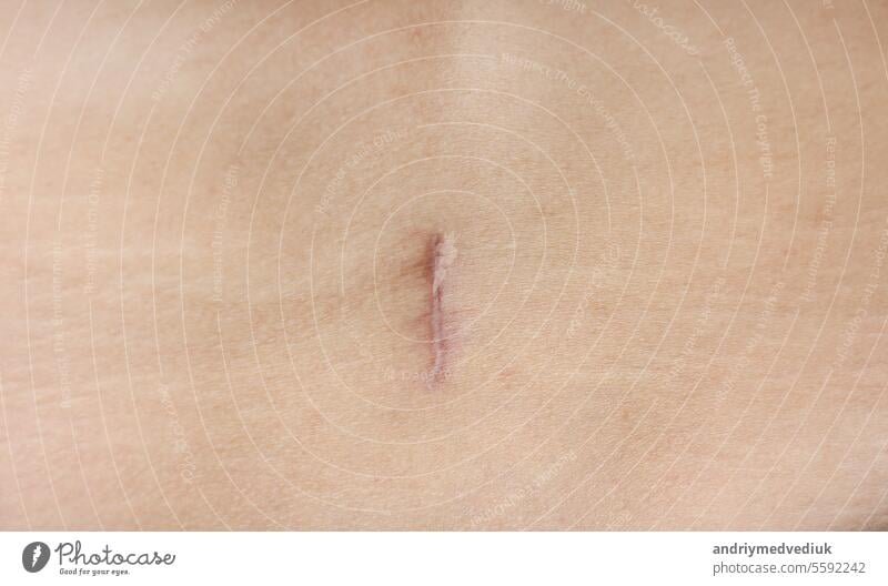 close up of careful scar after surgery on the body. skin medical health medicine operation appendicitis closeup human pain treatment belly wound abdomen