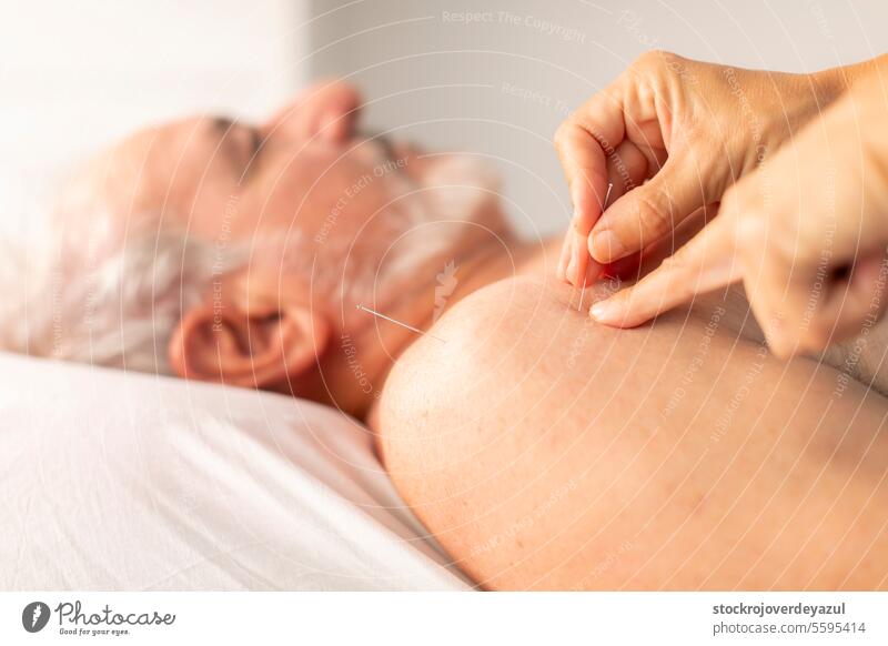 The hands of a physiotherapist place needles on the shoulder of an older man, during an acupuncture session in a physiotherapy clinic female treatment