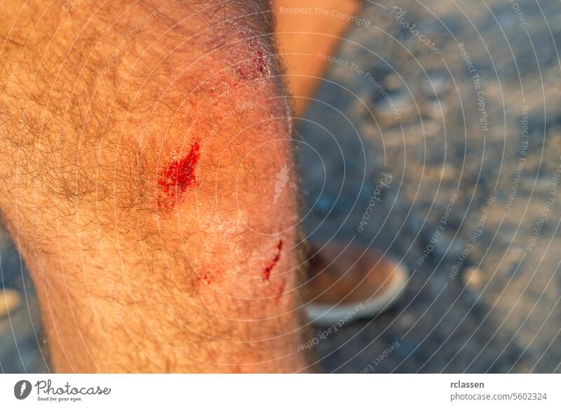 Close-up of a scraped and bloody knee with leg hair scraped knee first aid wound skin abrasion bleeding accident human body pain emergency healthcare trauma red