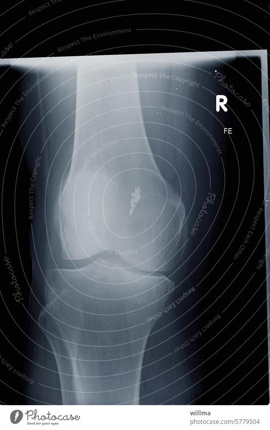 X-ray image after a kneecap fracture X-ray photograph Joint Knee Joint Fracture Knee cap Patella violation Patella fracture Breakage X-ray diagnostics Diagnosis