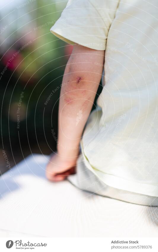 Close-up of child's scraped elbow in sunlit garden bruise minor injury close-up outdoor play accident care skin sunlight daylight hurt pain safety childhood