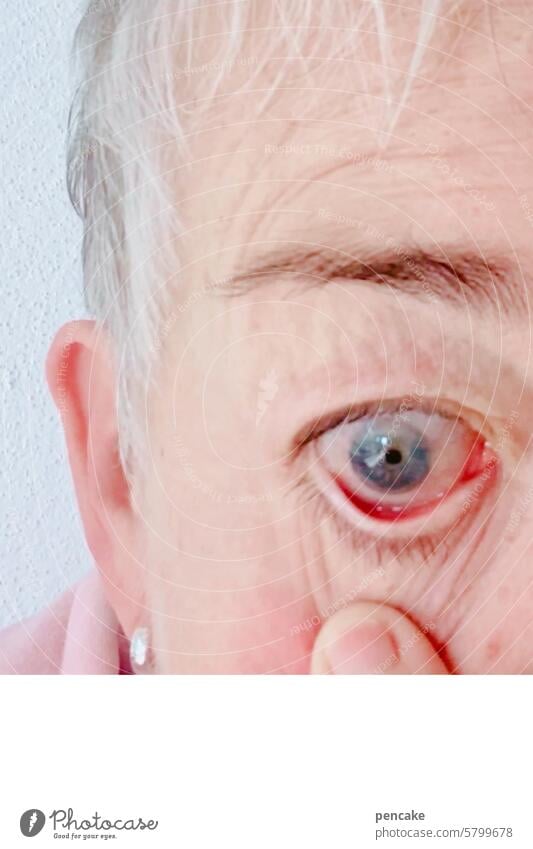 zähne zsmmnbßn | bakterielle konjunktivitis Auge rot Entzündung Konjunktivitis krank Bakterien Nahaufnahme Detail