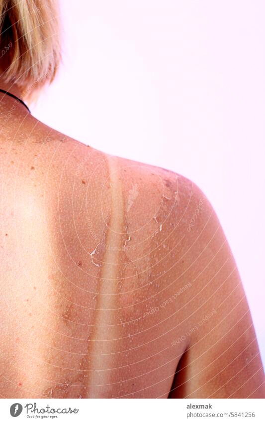 Back burnt after sunburn scald back body skin red pink cancer trace summer allergy cancerous care caucasian damage dangerous female girl health hot hurt pain