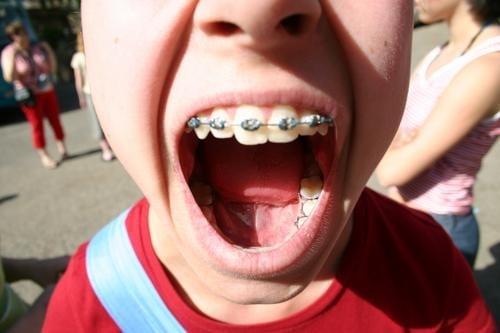 Open your mouth! Braces Girl Glittering Loud Red Protest Exterior shot Healthy Anger Aggravation Child Mouth Silver Tongue Lips Scream Blue Skin Nose